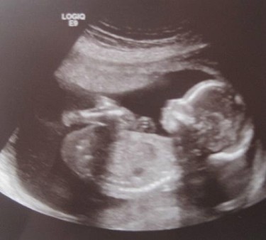 Unborn baby at 20 weeks.